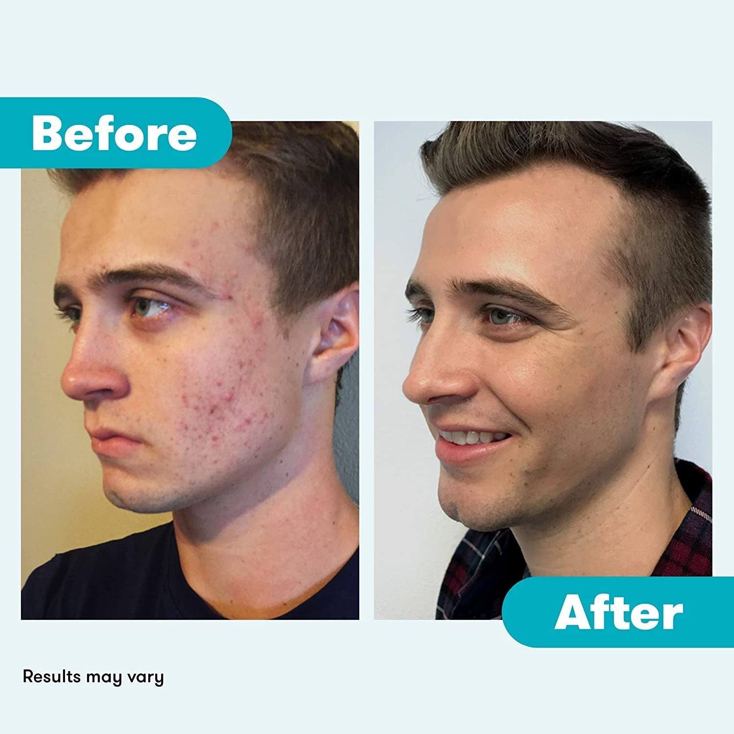 Acne Cleanser - Benzoyl Peroxide Face Wash and Acne Treatment - Daily Facial Cleanser and Hyularonic Acid Moisturizer with Exfoliating Beads - 90 Day Supply, 6 Fl Oz